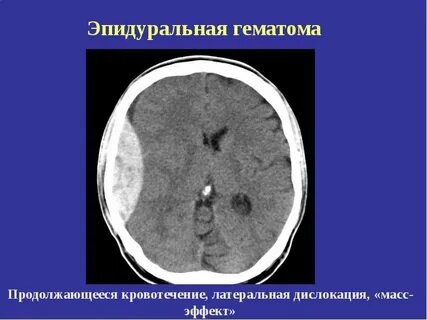 Гематома после эпидуральной