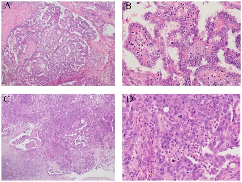 Назофарингеальная аденокарцинома. Карцинома высокой степени. Неинвазивная папиллярная уротелиальная карцинома low grade. Миоэпителиальная карцинома. Уротелиальная карцинома мочевого пузыря гистология.