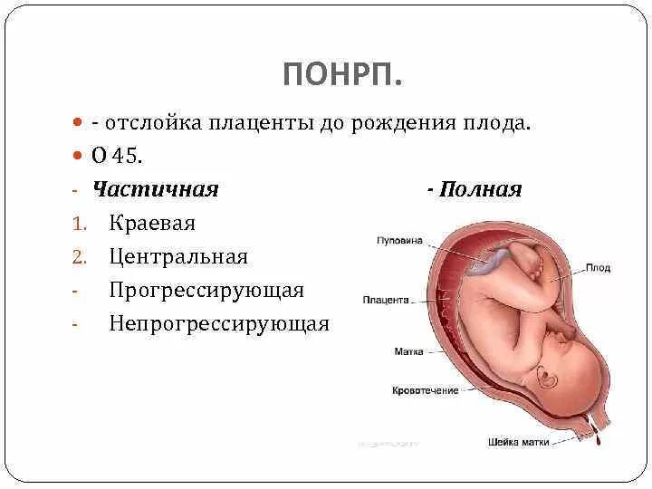 Отслойка плаценты у беременных. Полная и частичная отслойка плаценты. Отслойка при беременности 1 триместр. Плацентарная отслойка при беременности. Плацента на рубце матки
