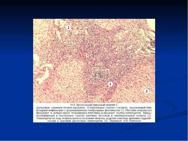 Хронический активный вирусный гепатит микропрепарат. Цирроз печени гепатит гистология. Хронический гепатит печени микропрепарат. Патанатомия вирусного цирроза печени. Печень микропрепарат описание