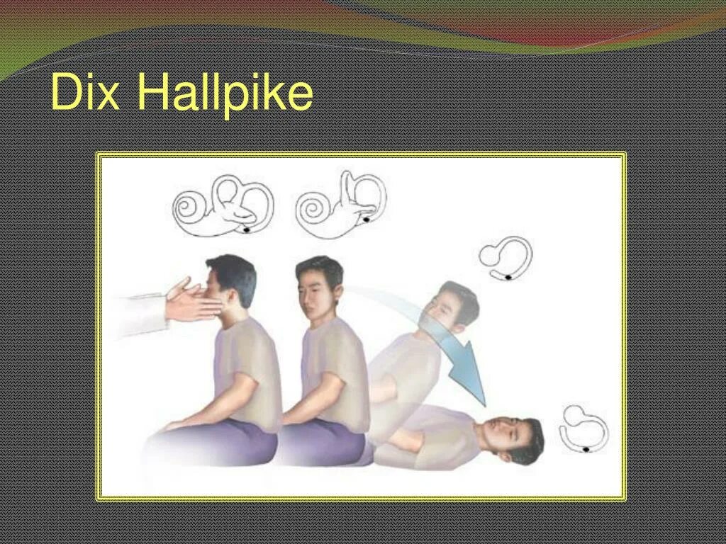 Проба холпайка. Dix Hallpike. Dix Hallpike maneuver. Проба Дикса-Холлпайка. Манёвр Dix и Hallpike.