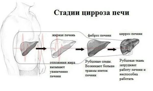 Цирроз печени какие стадии. Цирроз печени стадии развития. этапы развития цирроза печени. стадии поражения печени. стадии разрушения печени.