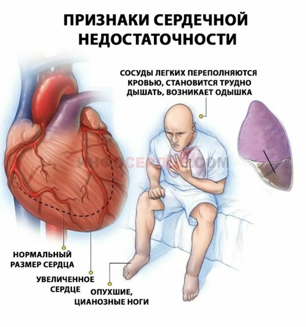 Симптомы острой сердечной недостаточности. Острая сердечная недостаточность симптомы. Острая сердечная сосудистая недостаточность симптомы. Симптомы при острой ХСН. Сердечная недостаточность у мужчин после 50