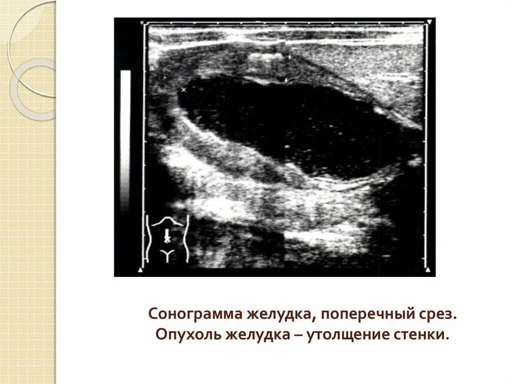 Норма толщины стенки желудка на УЗИ. Эхографическое исследование желудка. Утолщение стенок желудка на УЗИ. Стенки желудка утолщены.