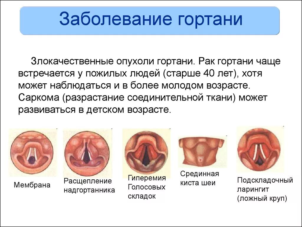 Заболевания голосовых