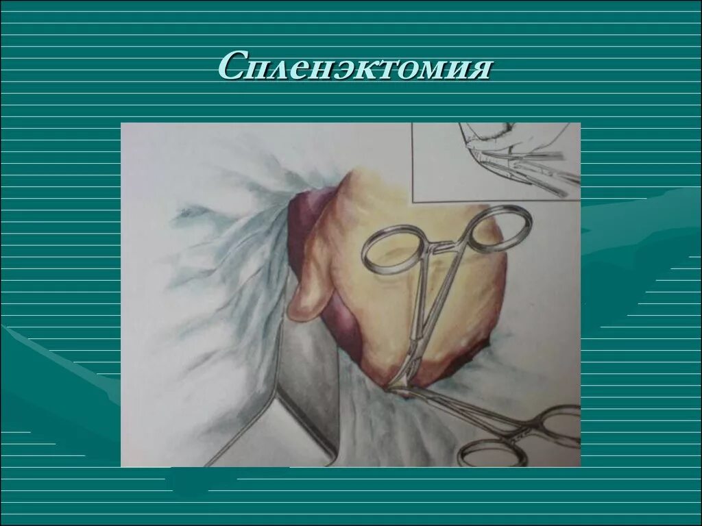 Спленэктомия что это. Этапы операции спленэктомии. Спленэктомия техника операции.