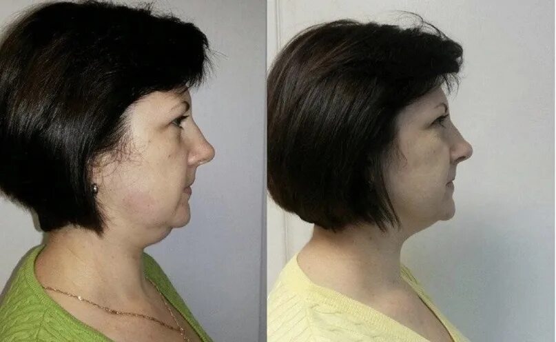 Липолитическая мезотерапия подбородка. Второй подбородок процедуры. Второй подбородок процедуры. Липолитик в подбородок до и после. Уколы от брылей на лице.