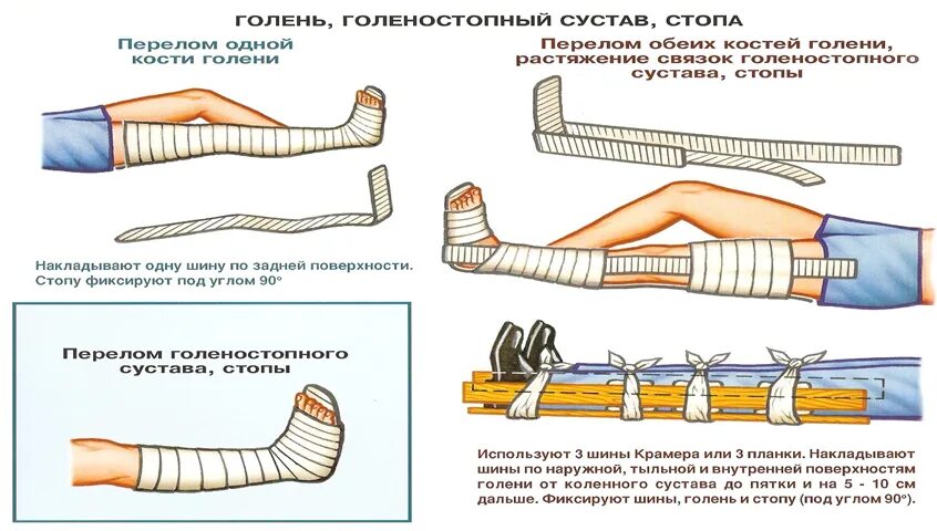 Кровотечение при открытом переломе голени. Наложение шины на открытый перелом. Правила наложения шины. Наложение жгута при открытом переломе.