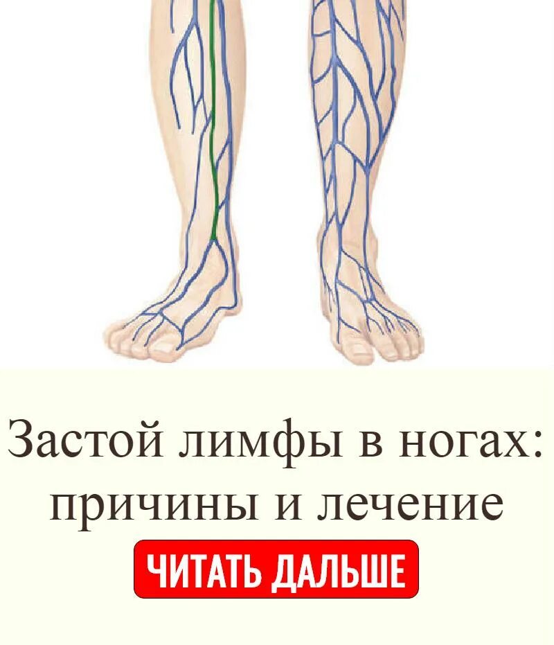 Народные средства от лимфостаза. Мазь от лимфостаза ног. Лимфатический отек ног. Лимфа на ногах лечение. Лимфатический отек голени.