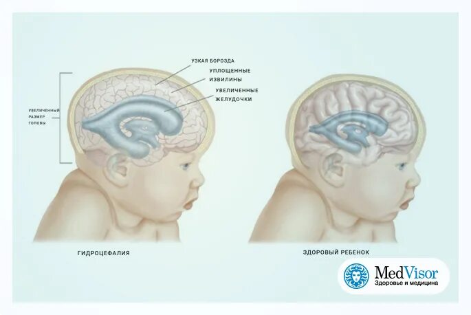 Гидроцефалия желудочков головного мозга. Гидроцефалия головного мозга у грудничка. Наружная гидроцефалия головного мозга у новорожденного. Гидроцефалия норма желудочков. Расширение желудочков дети