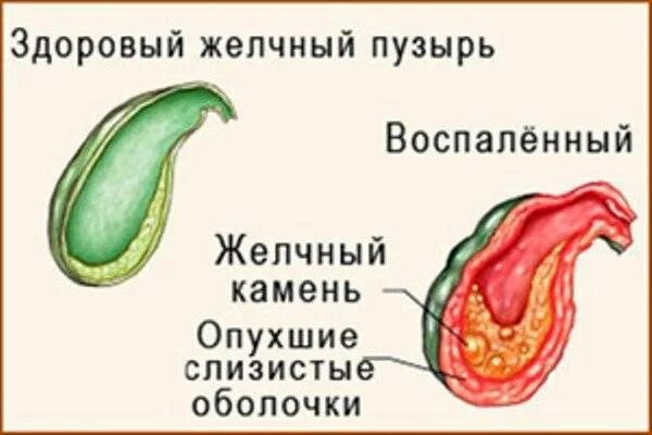 Боль в желчном пузыре чем снять. Воспаление желчного пузыря. Здоровый желчный пузырь. Жёлчный пузырь симптомы.