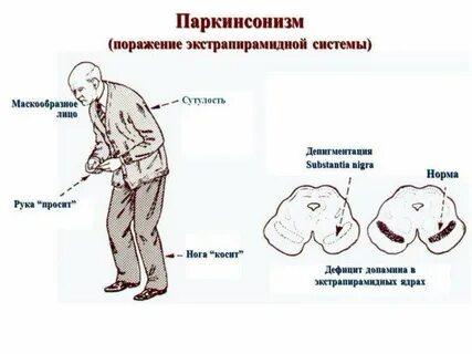 Болезнь паркинсона сколько с ней живут
