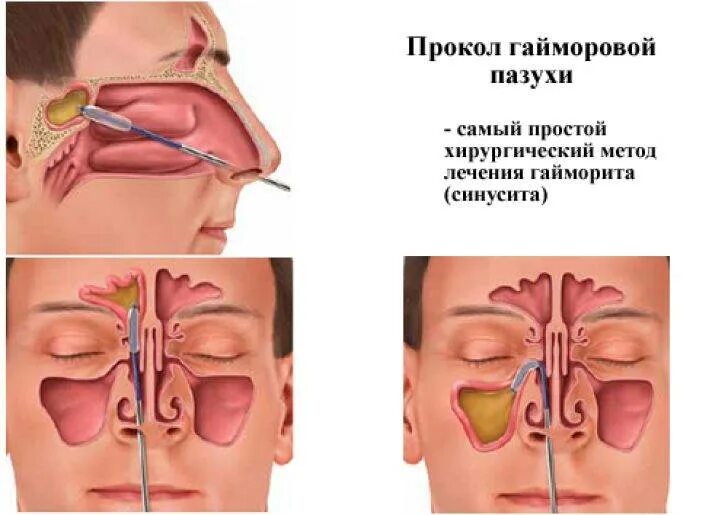 Синусит можно греть нос. Пазухи носа анатомия гайморит. Пункция верхнечелюстной пазухи при синусите. Гайморовые пазухи, гайморит. Гайморит - воспаление слизистой оболочки верхнечелюстной пазухи;.