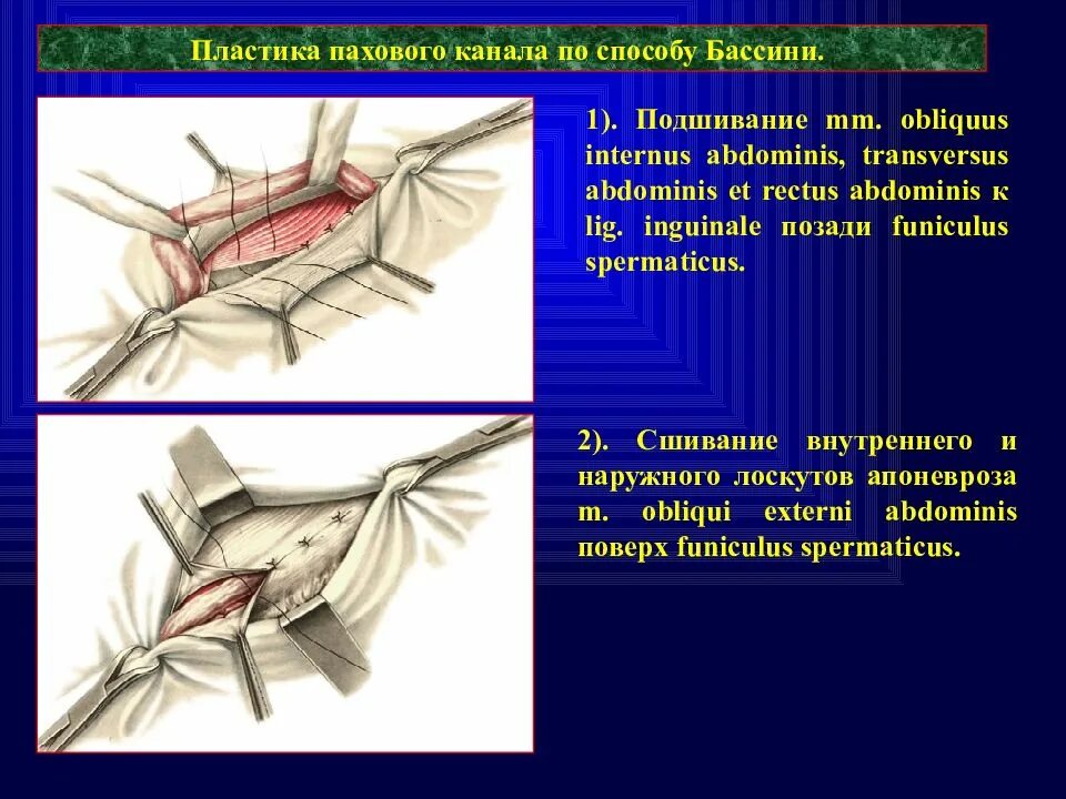 Паховая грыжа методы лечения. Паховая грыжа по Бассини техника. Паховая грыжа способ Бассини. Пластика пахового канала по Бассини.