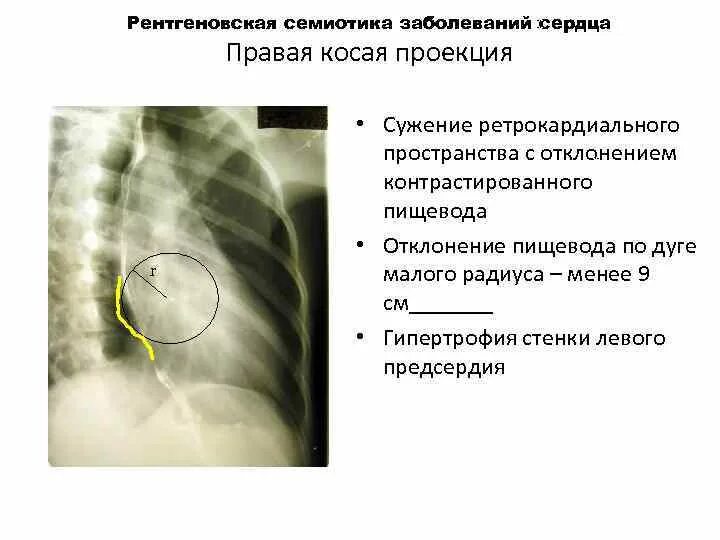 Отклонение пищевода по дугам малого и большого радиусов. Отклонение пищевода по дуге малого радиуса и большого радиуса. Косая проекция сердца. Отклонение пищевода по малому радиусу.