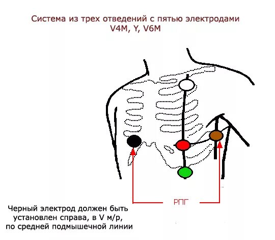 Расположение электродов при холтеровском мониторировании фото Техника снятия электрокардиограммы