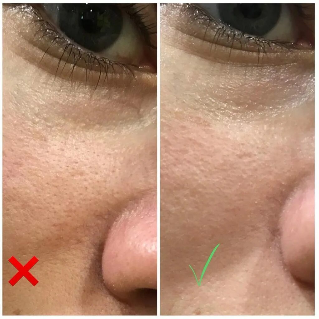 Пилинг головы до после. Пилинг кожи головы до и после. Трихоскопия кожи головы. Волосы перхоть до после. Пилинг кожи головы до и после.