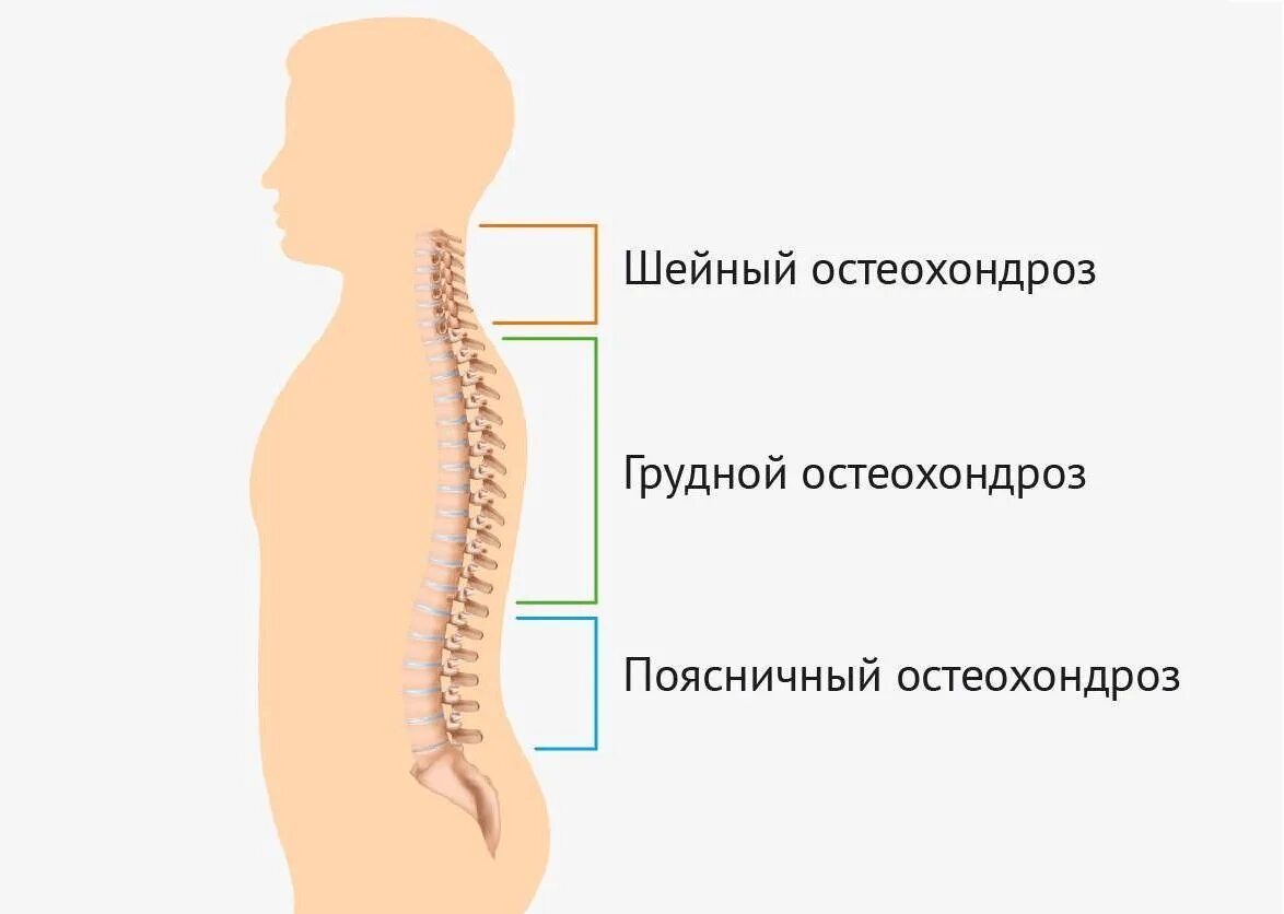 Остеохондроз th5-th8. Остеохондроз шейно-грудного отдела позвоночника. Ostaxondroz. Остеохондроз грудного и поясничного отделов позвоночника.