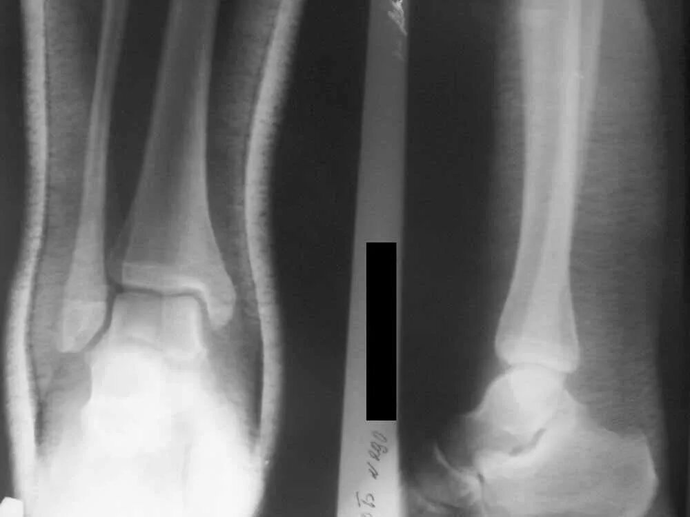 Добавочные кости голеностопного сустава. Разрыв дистального синдесмоза голеностопного сустава. Разрыв дистального межберцового синдесмоза рентген. Перелом лодыжек разрыв синдесмоза. Перелом мезоннева лодыжки.