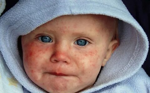 Заболеть краснухой после прививки