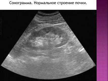 Сонограмма