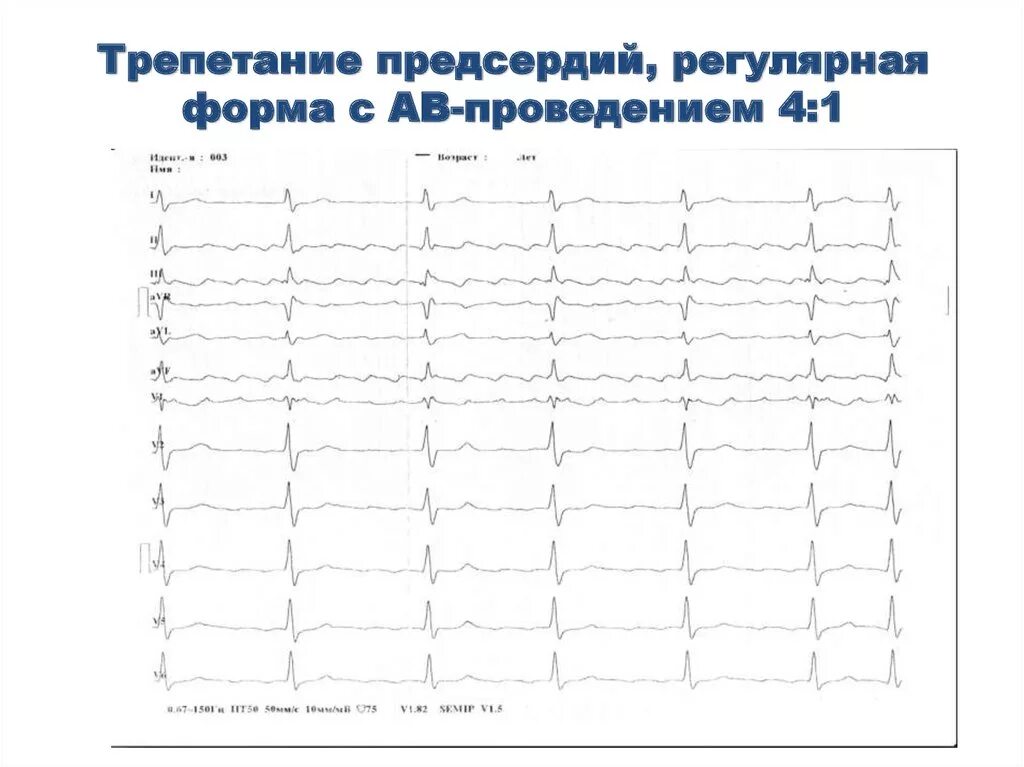 Трепетание предсердий 2 1. Трепетание предсердий 4 к 1 на экг. трепетание предсердий 1:1. трепетание предсердий регулярная форма. трепетание предсердий с проведением 1 к 1.