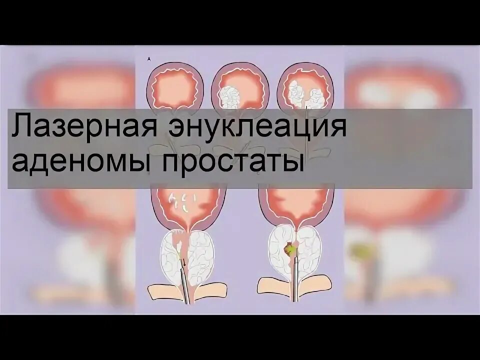 Лазерная энуклеация предстательной. Трансуретральная лазерная энуклеация. Лазерная энуклеация аденомы. Гольмиевая лазерная энуклеация предстательной железы. Энуклеация аденомы простаты.