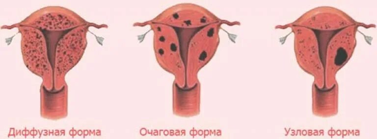 Диффузная матка
