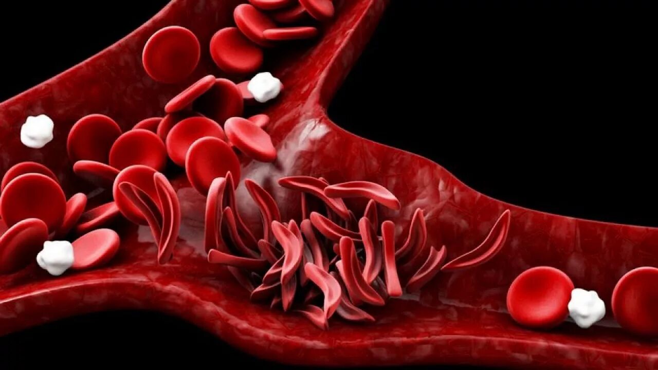 Ген серповидноклеточной анемии. Серповидная клеточная анемия гемоглобин. Серповидная анемия эритроциты. Серповидноклеточная анемия гистология.