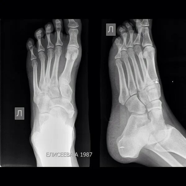 Does this look like just a "bruised foot" to you? Page 2 Sherdog Forums UFC, MMA