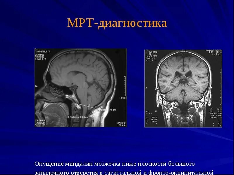 Пролабирование мозжечка. Опущение миндалин мозжечка мрт. киари миндалины мозжечка.