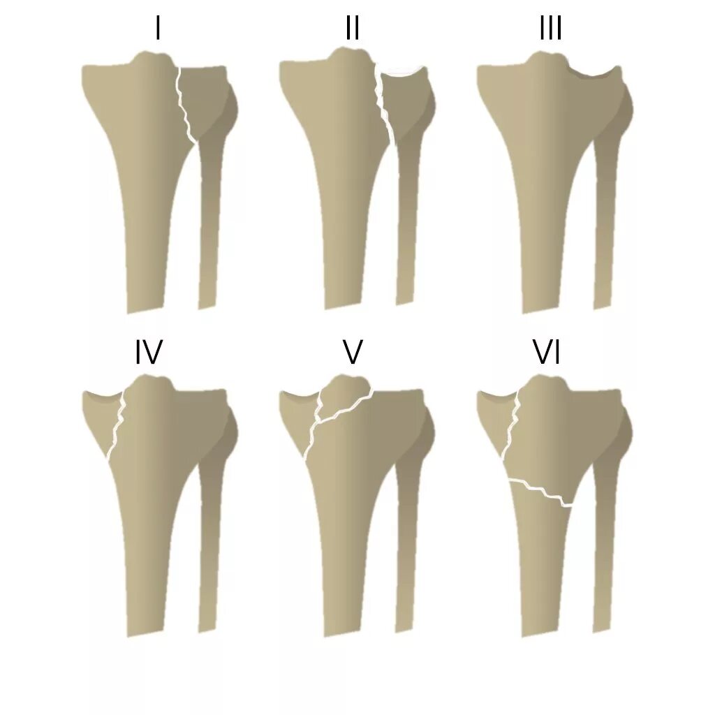 Перелом мыщелков большеберцовой кости. Перелом латерального мыщелка большеберцовой кости классификация. Переломы мыщелков большеберцовой кости классификация. Перелом проксимального отдела большеберцовой кости.