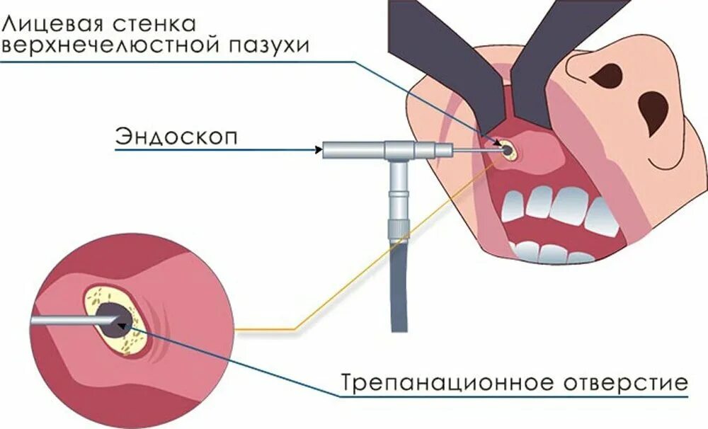 Киста левой верхнечелюстной пазухи операция. Эндоскопическая гайморотомия гайморовой пазухи. Киста правой верхнечелюстной пазухи эндоскопическая операция. Эндоскопическая гайморотомия с двух сторон. Заняться отверстие