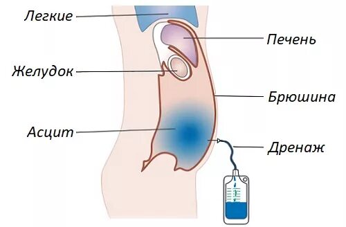Лапароцентез это. Лапароцентез при асците. дренирование при асците.