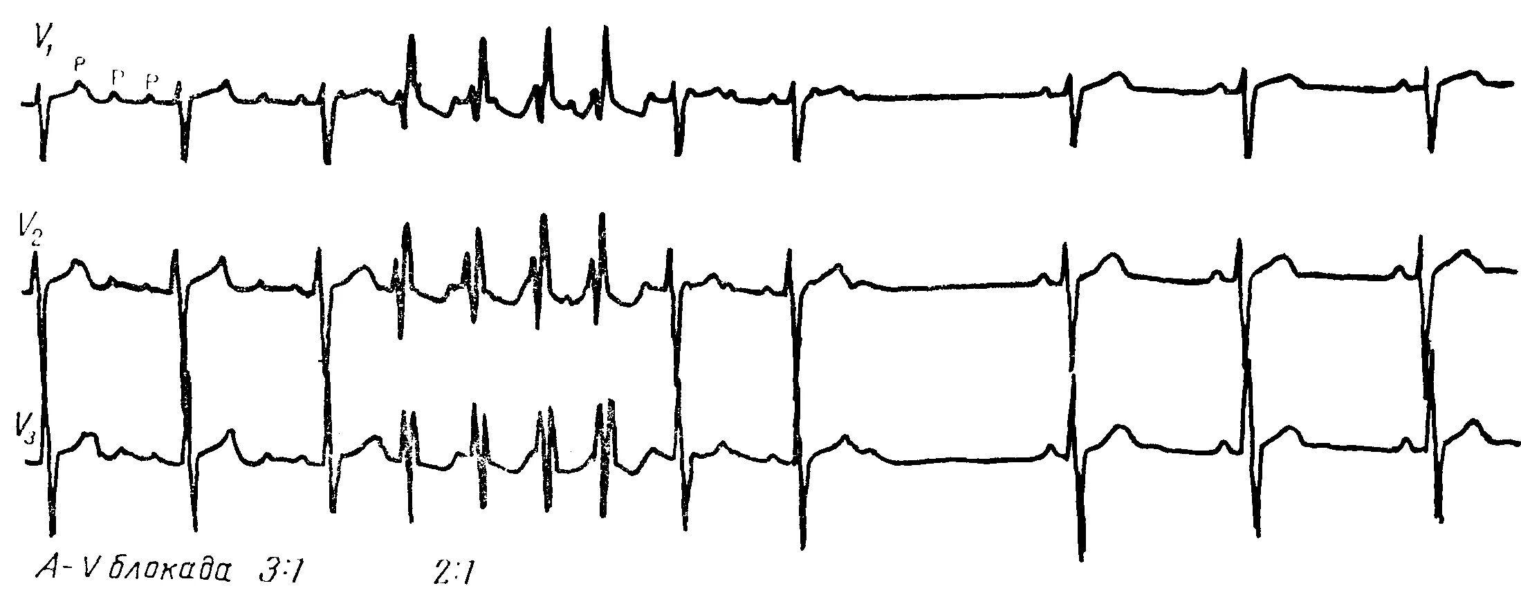 Предсердная блокада. Предсердная тахикардия 2 к 1. Предсердная тахикардия с АВ блокадой 2 степени на ЭКГ. Наджелудочковая тахикардия с АВ блокадой 2. Предсердная тахикардия с блокадой.