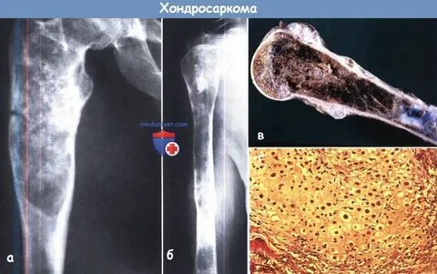 Хондросаркома