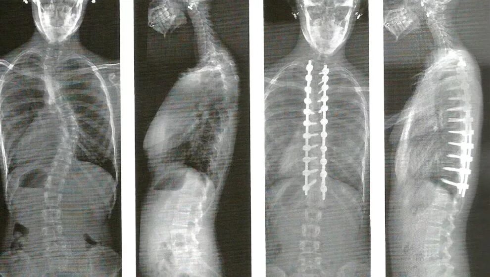Операция фиксация позвоночника. Спондилодез шейного отдела рентген. Дорсальный спондилодез. Вентральный спондилодез.