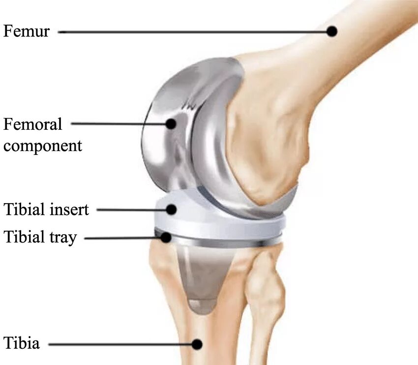 Коленный эндопротез Зиммер. Stryker протез коленного сустава. Эндопротезы Zimmer коленного сустава. Эндопротез локтевого сустава Зиммер.