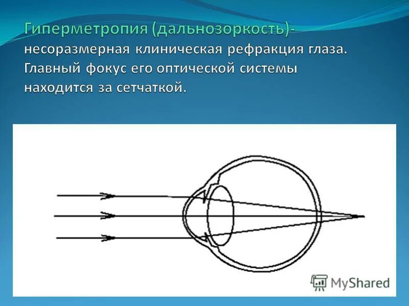 Гиперметропия средней степени глаза