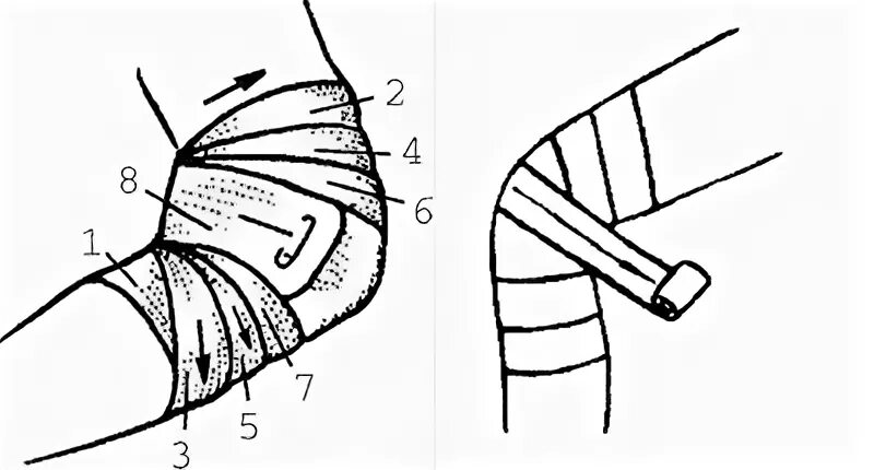 Черепашья сходящаяся на локтевой сустав повязка. Черепашья повязка на локтевой сустав. Типы бинтовых повязок черепашья расходящаяся на коленный сустав. Наложение черепашьей повязки на локтевой сустав. Как перевязывать колено
