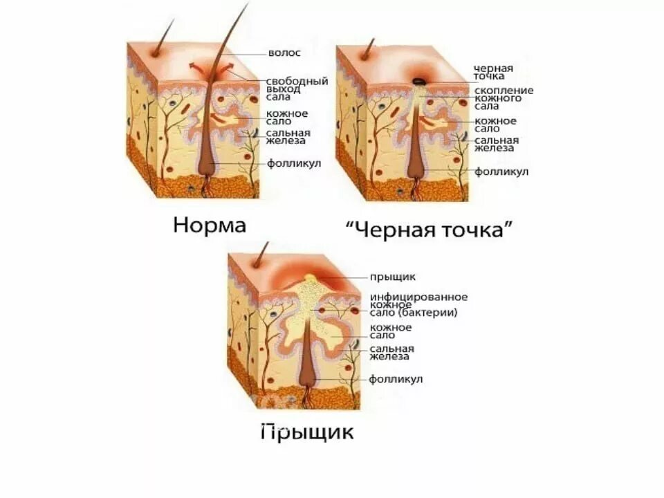 Что сделать чтобы прыщ быстрее прошел. Что сделать чтобы прыщ быстрее прошел