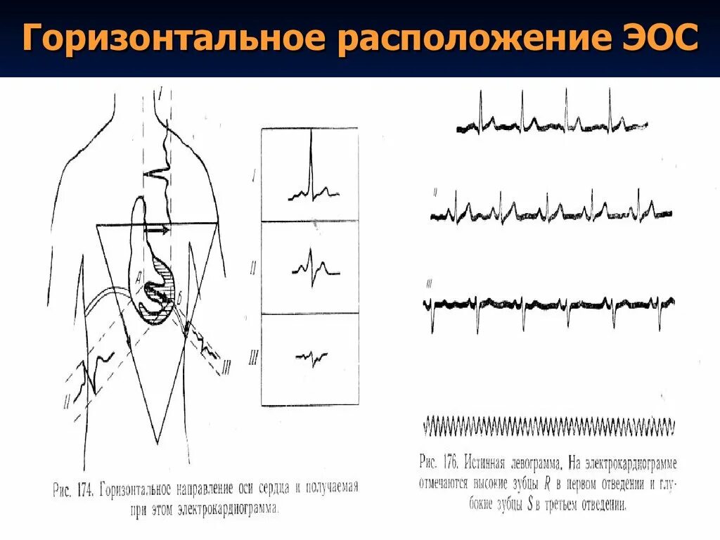 Вертикальная позиция сердца. Горизонтальное расположение ЭОС на ЭКГ. При ЭКГ электрическая ось горизонтальная. Горизонтальное положение электрической оси сердца на ЭКГ. Электрическая ось горизонтальная на ЭКГ что это.