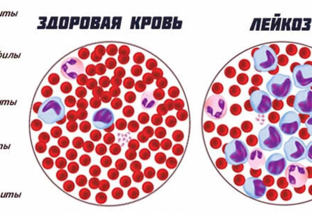 Лейкоз эритроциты. Лейкоз эритроциты