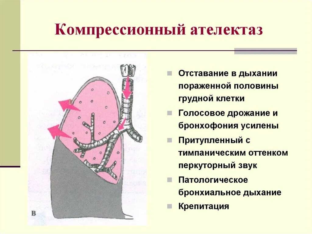 Компрессионный ателектаз бронхиальное дыхание. Компрессионный и обтурационный ателектаз легкого. Компрессионный ателектаз голосовое дрожание. Компрессионный ателектаз легкого