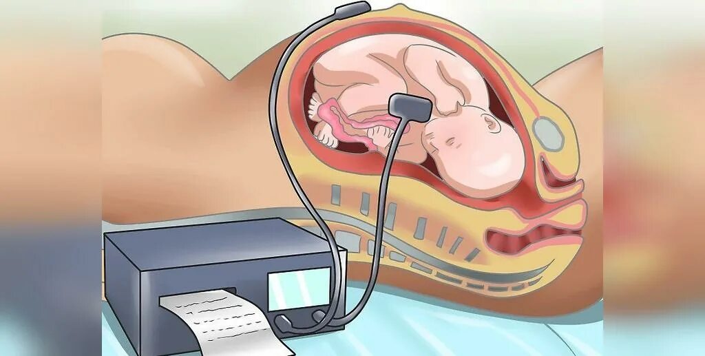 Исследование сердцебиения плода. АКТГ сердцебиение плод. Кардиотокография плода (КТГ). Аппарат КТГ. Аппарат КТГ плода.