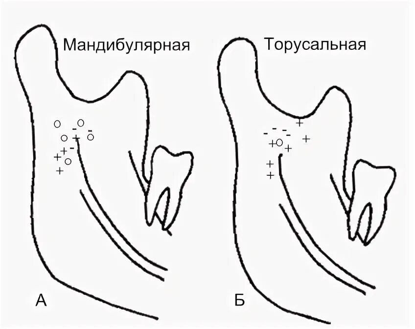 Торусальная анестезия схема проведения. Торусальная анестезия по м.м Вейсбрему. Мандибулярная анестезия схема. Торусальная анестезия в стоматологии схема. Гоу гейтс