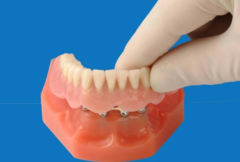 Съемный протез ivocap [ивокап]. Частичный съемный пластиночный протез на 1 зуб. "съемный протез из термопластичного материала "t-crystal". Акри-фри протезы перфлекс. 036.