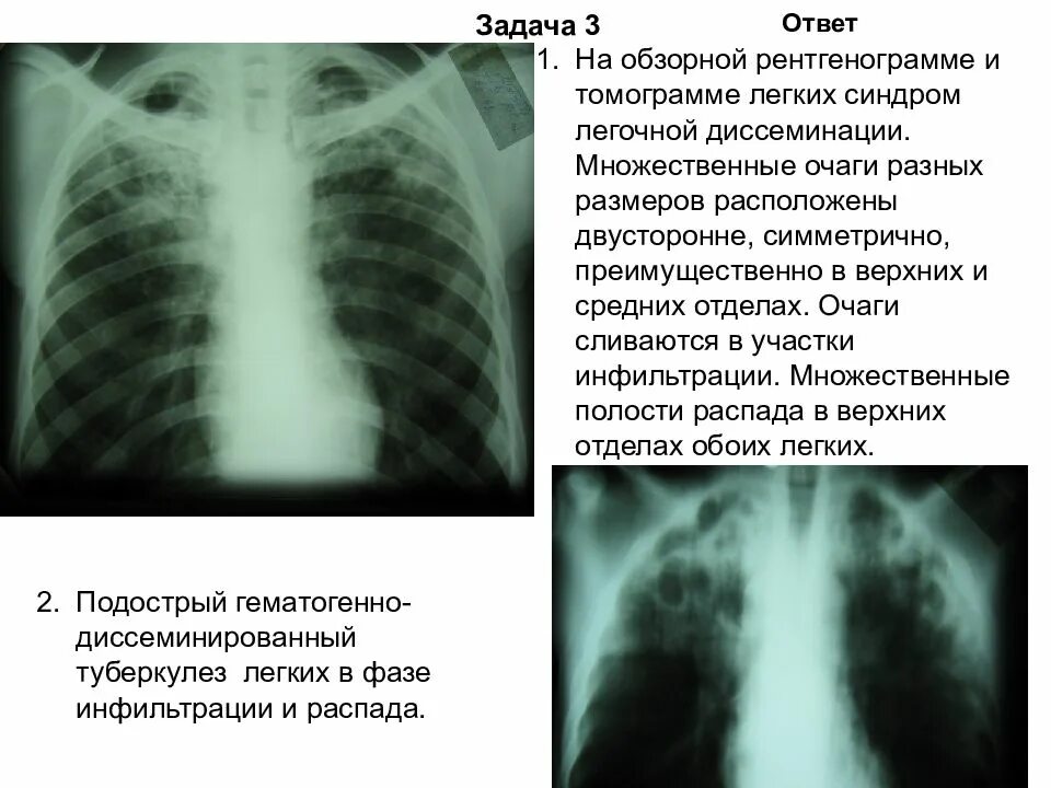 Диссеминированный туберкулез фаза инфильтрации. Диссеминированный туберкулез легких описание рентгенограммы. описание рентгенограммы диссеминированного туберкулеза. подострый диссиминированный туберкулёз рентген. описание диссеминированного туберкулеза на рентгене.