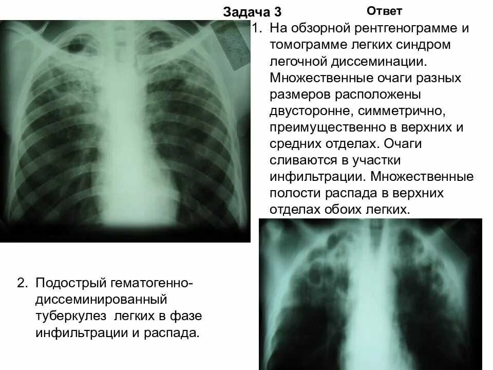 Диссеминированный туберкулез легких фазы. Диссеминированный туберкулез легких описание рентгенограммы. Описание рентгенограммы диссеминированного туберкулеза. Подострый диссиминированный туберкулёз рентген. Описание диссеминированного туберкулеза на рентгене.