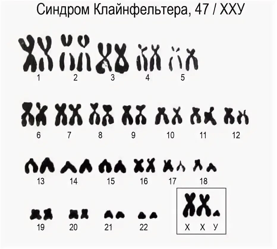 Отсутствие х хромосомы у мужчин. Кариотип человека с синдромом Клайнфельтера. Кариотип человека синдром клайфе. Кариотип больного с синдромом Клайнфельтера. Кариотип больных с синдромом Клайнфельтера.